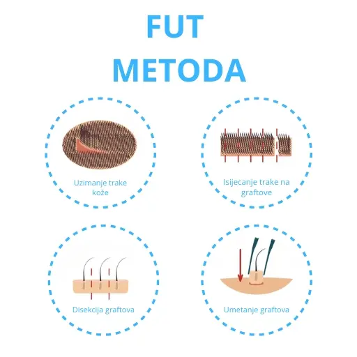 FUT METODA